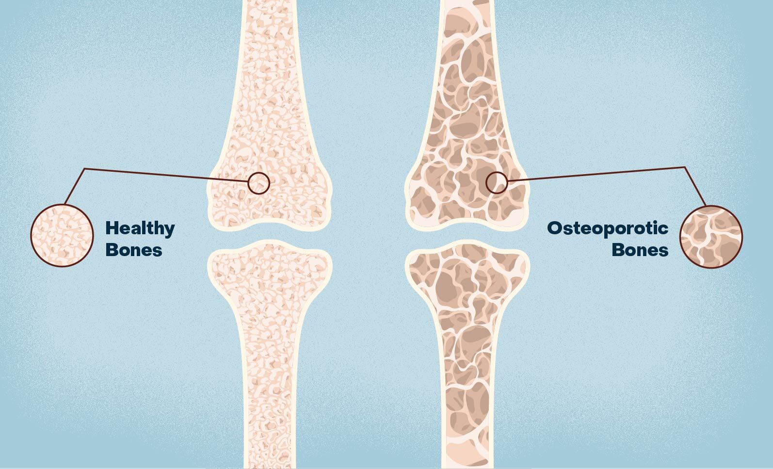 Osteoporosis