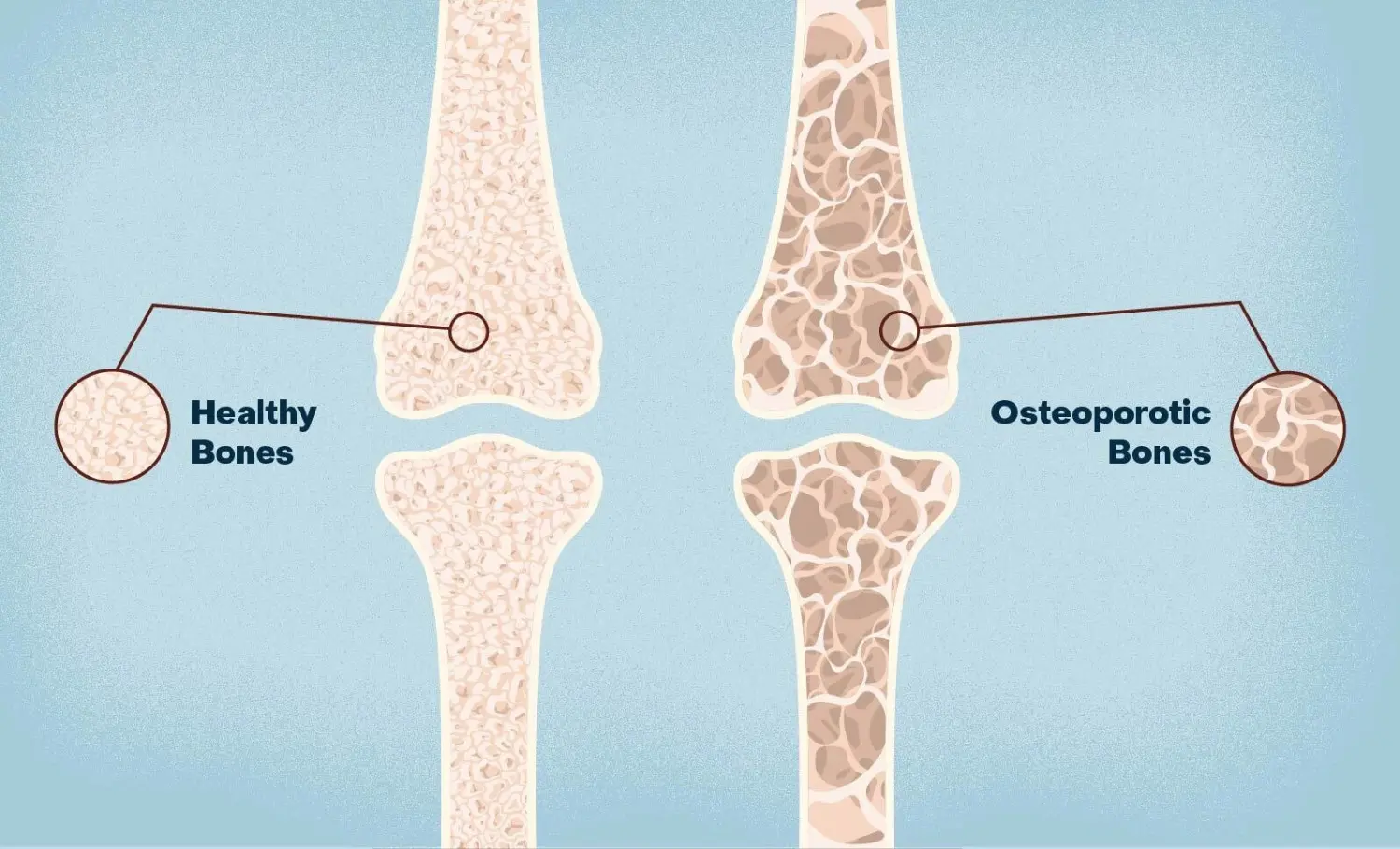 Osteoporosis